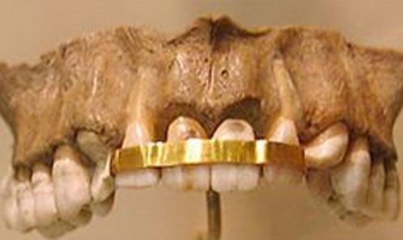 Egypte antique - intervention dentaire ou bijou ?